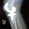 Knee Replacement